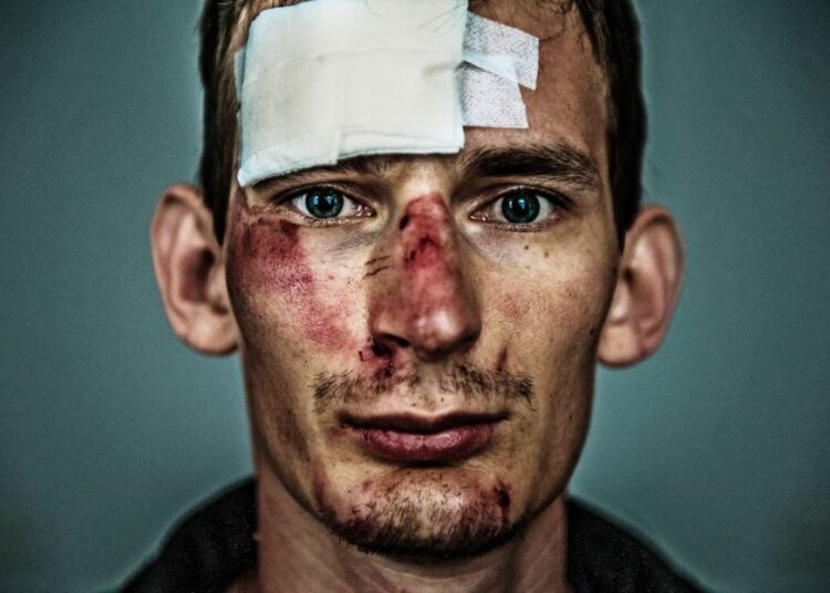 How Much Does Road Accident Fund Pay for Head Injury in South Africa
